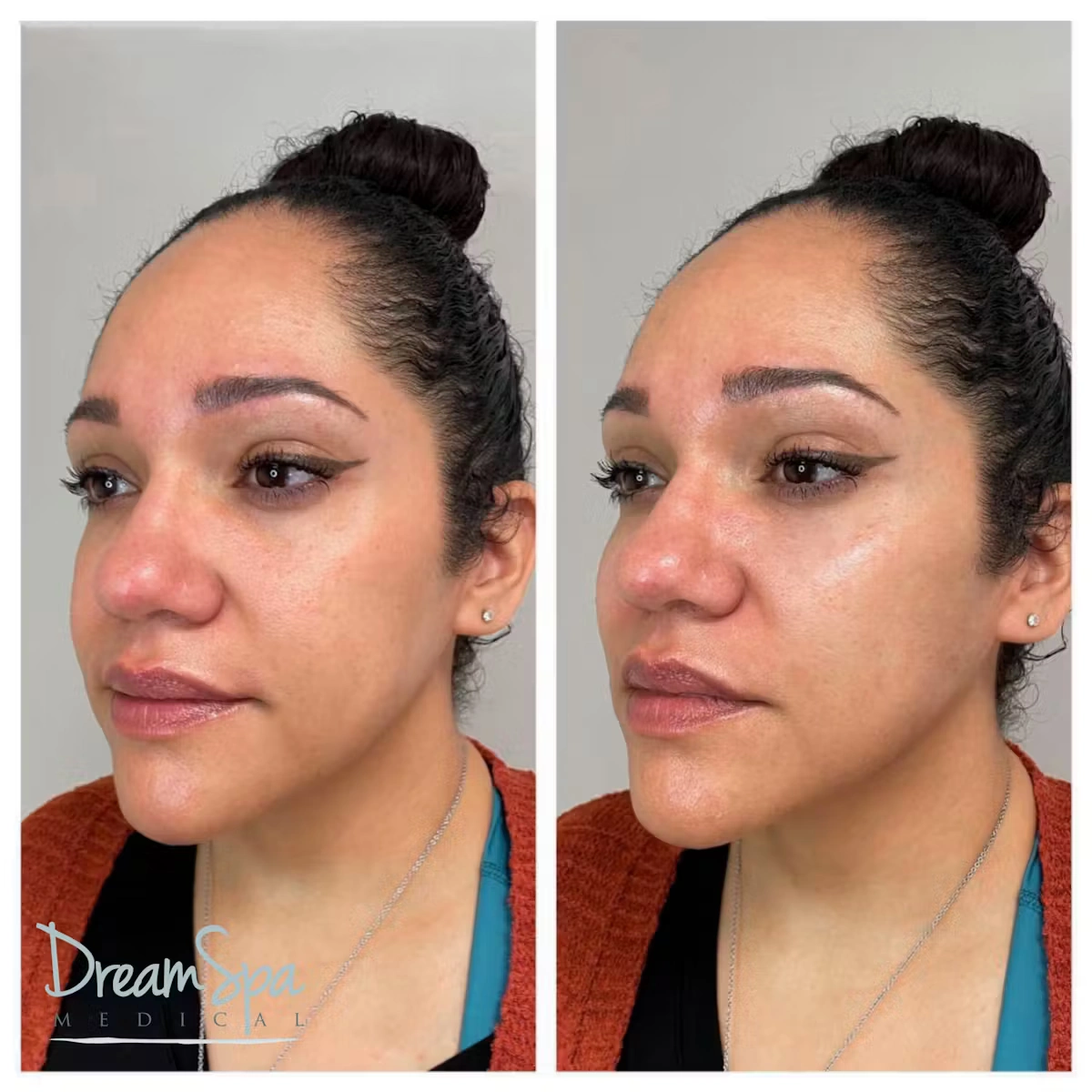 cheek filler before and after