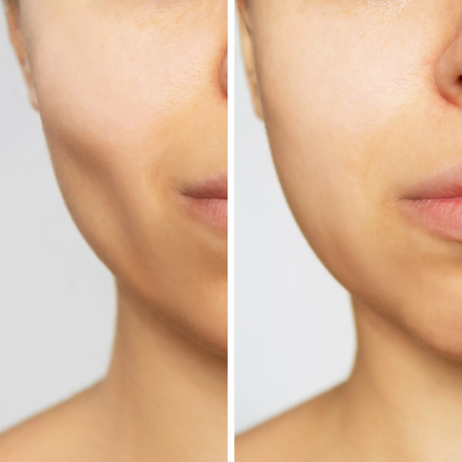 cheek filler before and after 