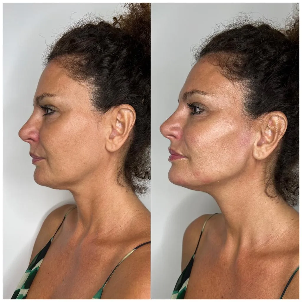 cheek filler before and after 