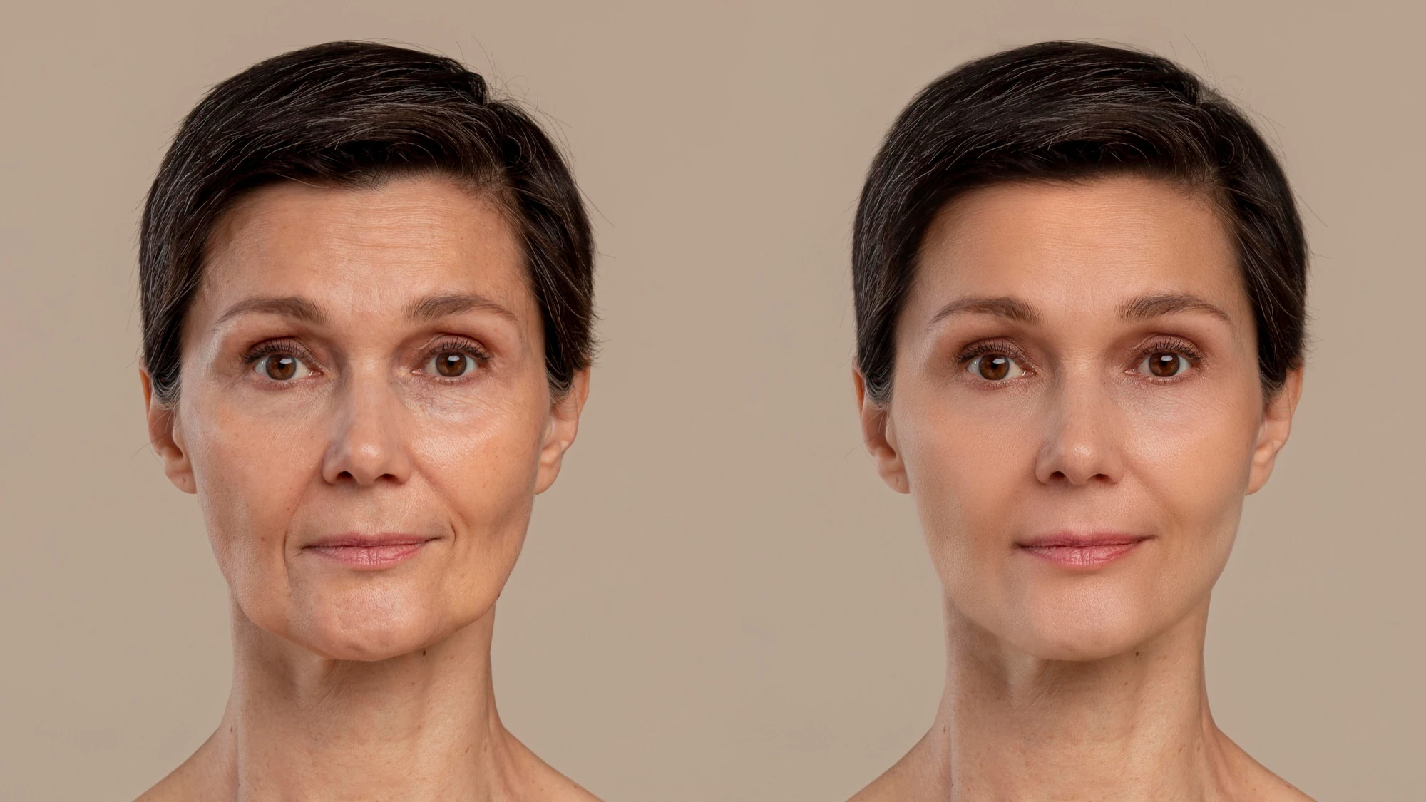 Result of Hyaluronic Acid Before and After