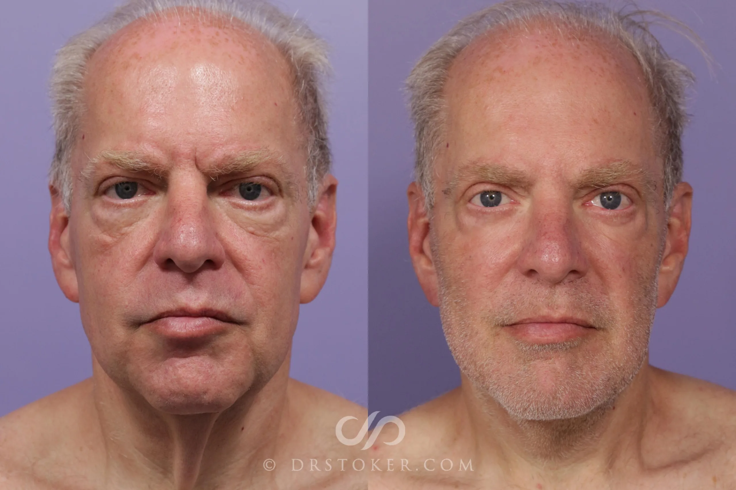 Hyaluronic Acid Before and After: Acid Magic